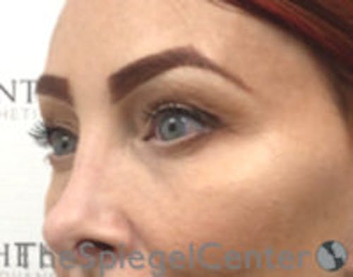 Blepharoplasty Before & After Gallery - Patient 809763 - Image 4