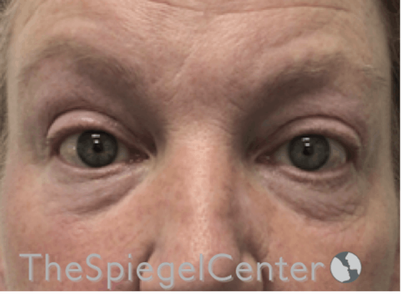 Blepharoplasty Before & After Gallery - Patient 346413 - Image 1