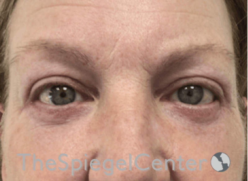 Blepharoplasty Before & After Gallery - Patient 346413 - Image 2