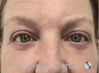 Blepharoplasty Before & After Gallery - Patient 346413 - Image 2
