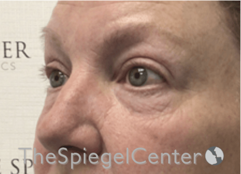 Blepharoplasty Before & After Gallery - Patient 346413 - Image 3