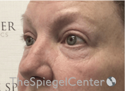 Blepharoplasty Before & After Gallery - Patient 346413 - Image 3