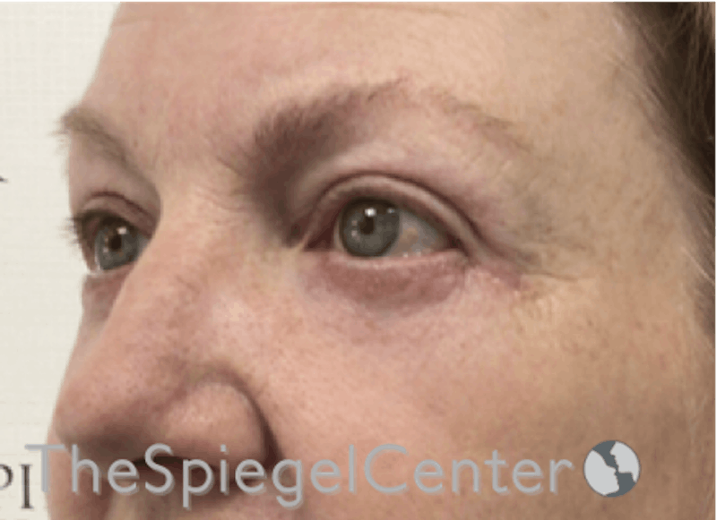 Blepharoplasty Before & After Gallery - Patient 346413 - Image 4
