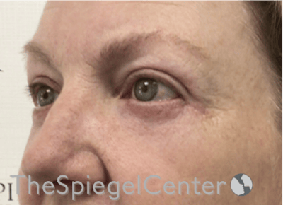 Blepharoplasty Before & After Gallery - Patient 346413 - Image 4