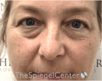 Blepharoplasty Before & After Gallery - Patient 331593 - Image 1