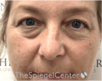 Blepharoplasty Before & After Gallery - Patient 331593 - Image 1
