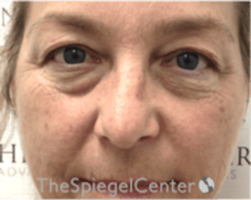 Blepharoplasty Before & After Gallery - Patient 331593 - Image 1