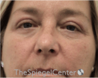Blepharoplasty Before & After Gallery - Patient 331593 - Image 2
