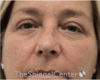 Blepharoplasty Before & After Gallery - Patient 331593 - Image 2