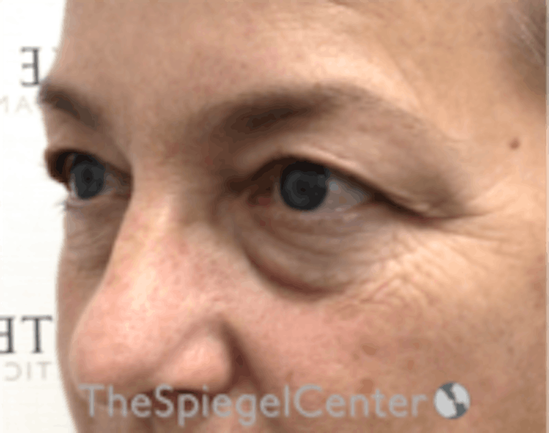 Blepharoplasty Before & After Gallery - Patient 331593 - Image 3