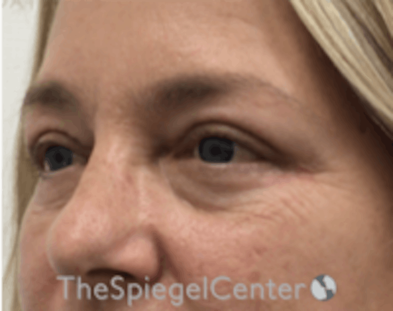 Blepharoplasty Before & After Gallery - Patient 331593 - Image 4
