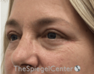 Blepharoplasty Before & After Gallery - Patient 331593 - Image 4