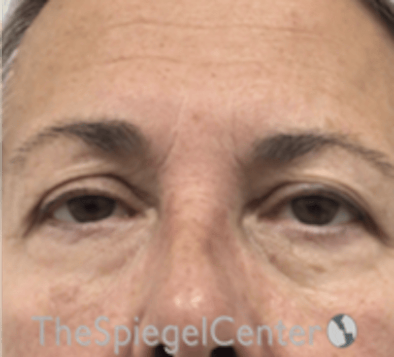 Blepharoplasty Before & After Gallery - Patient 106158 - Image 1
