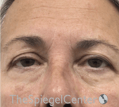 Blepharoplasty Before & After Gallery - Patient 106158 - Image 1