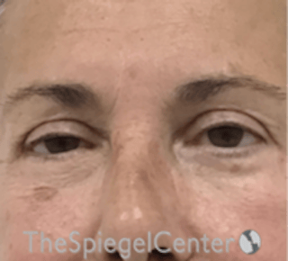 Blepharoplasty Before & After Gallery - Patient 106158 - Image 2