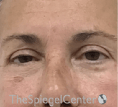 Blepharoplasty Before & After Gallery - Patient 106158 - Image 2