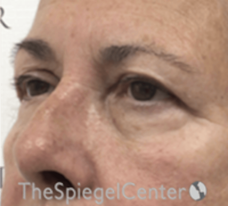 Blepharoplasty Before & After Gallery - Patient 106158 - Image 3