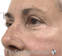 Blepharoplasty Before & After Gallery - Patient 106158 - Image 4