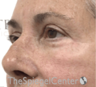 Blepharoplasty Before & After Gallery - Patient 106158 - Image 4