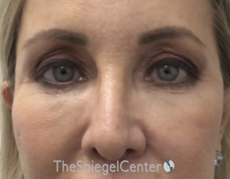 Blepharoplasty Before & After Gallery - Patient 163417 - Image 1