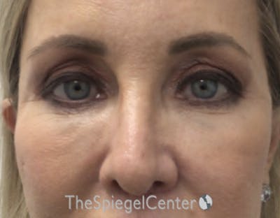 Blepharoplasty Before & After Gallery - Patient 163417 - Image 1