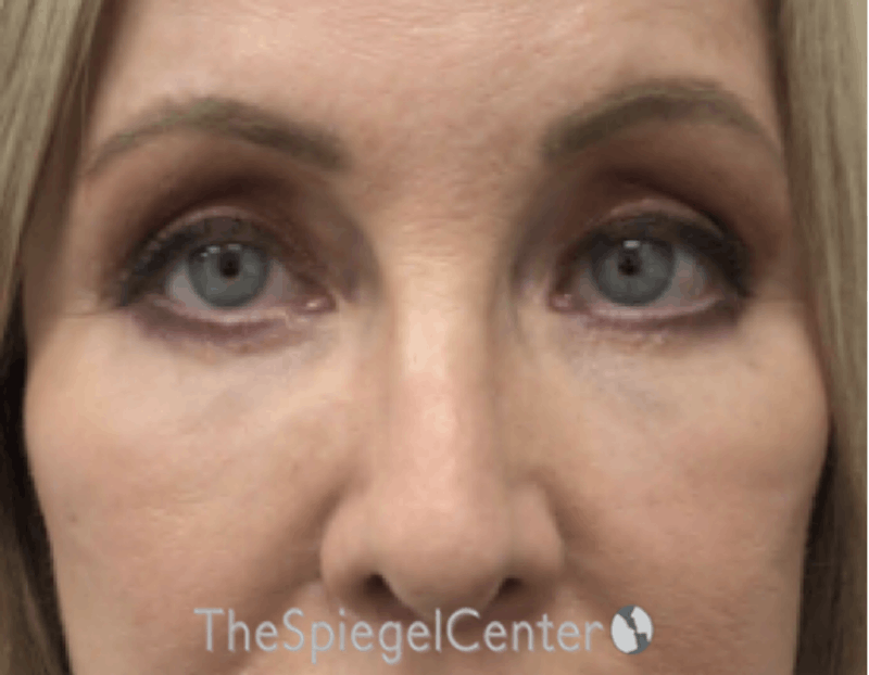Blepharoplasty Before & After Gallery - Patient 163417 - Image 2