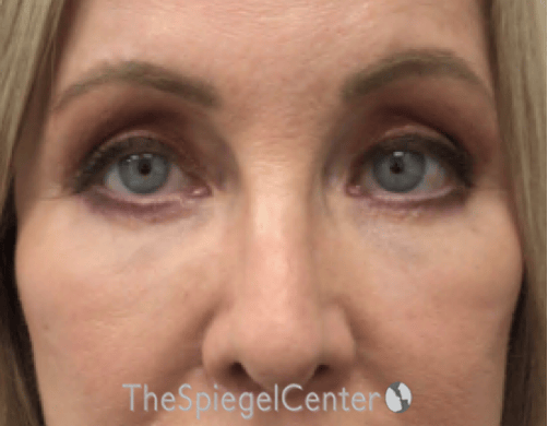 Blepharoplasty Before & After Gallery - Patient 163417 - Image 2