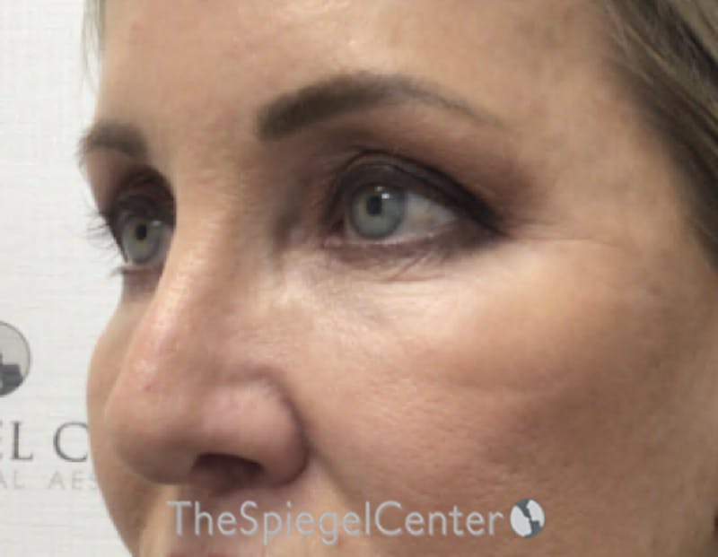 Blepharoplasty Before & After Gallery - Patient 163417 - Image 3