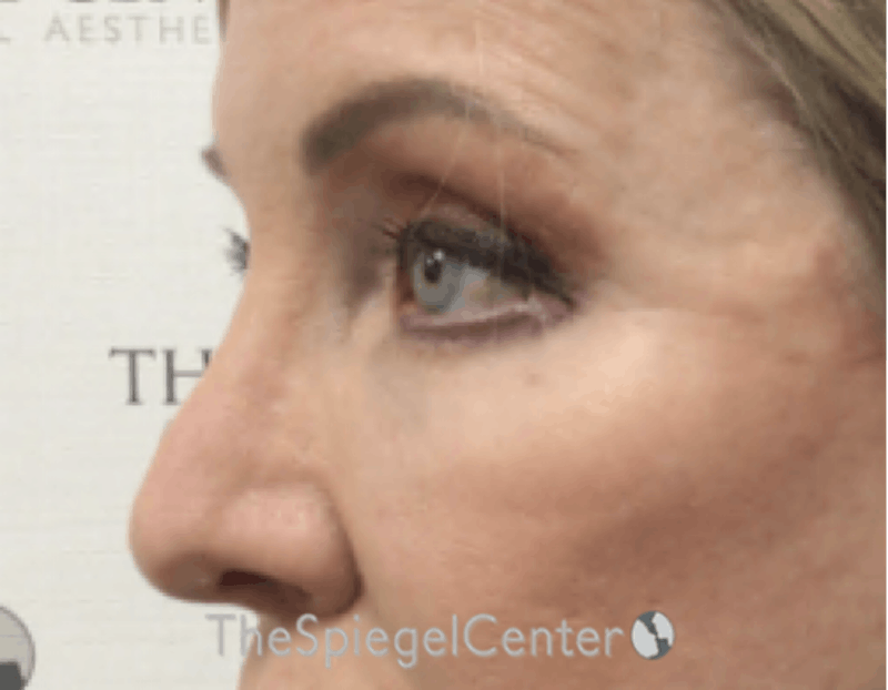 Blepharoplasty Before & After Gallery - Patient 163417 - Image 4