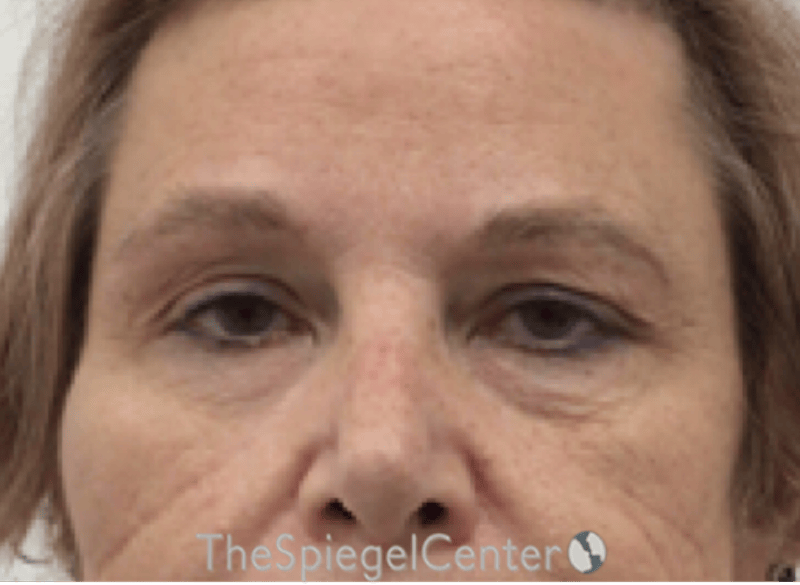 Blepharoplasty Before & After Gallery - Patient 221243 - Image 1