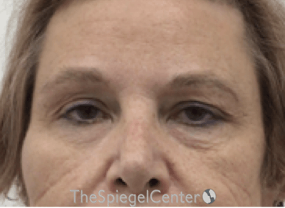 Blepharoplasty Before & After Gallery - Patient 221243 - Image 1