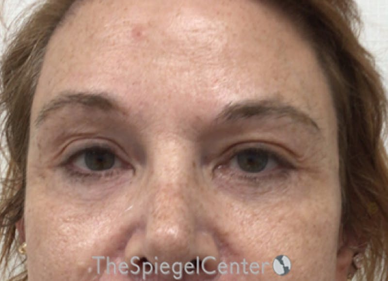 Blepharoplasty Before & After Gallery - Patient 221243 - Image 2