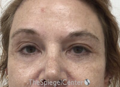 Blepharoplasty Before & After Gallery - Patient 221243 - Image 2