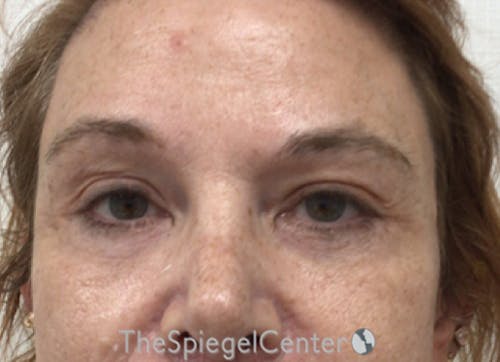 Blepharoplasty Before & After Gallery - Patient 221243 - Image 2