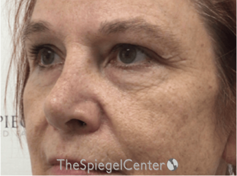 Blepharoplasty Before & After Gallery - Patient 221243 - Image 3