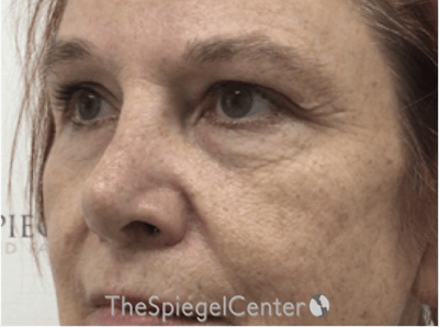 Blepharoplasty Before & After Gallery - Patient 221243 - Image 3