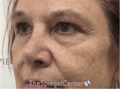 Blepharoplasty Before & After Gallery - Patient 221243 - Image 3