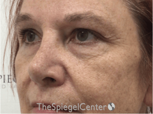 Blepharoplasty Before & After Gallery - Patient 221243 - Image 3