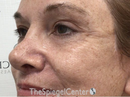 Blepharoplasty Before & After Gallery - Patient 221243 - Image 4