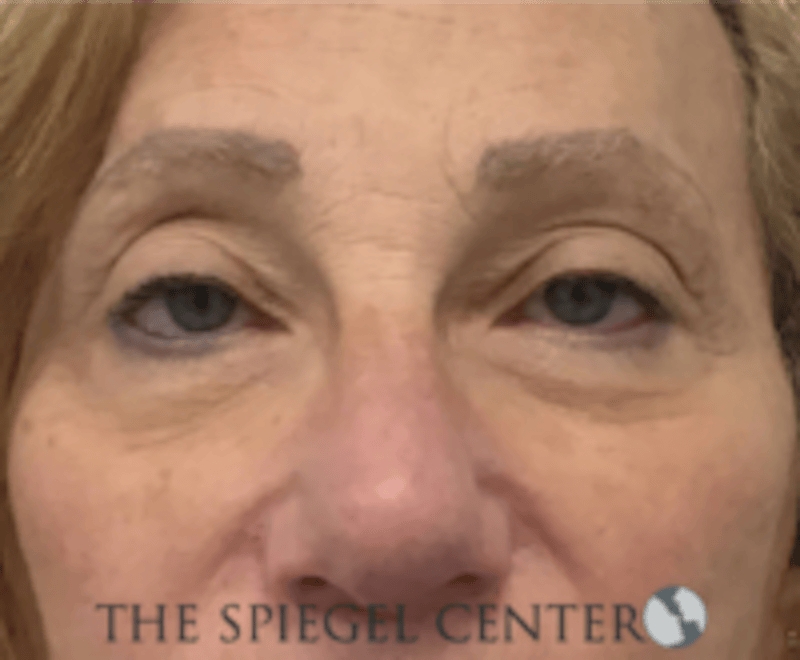 Blepharoplasty Before & After Gallery - Patient 136570 - Image 1