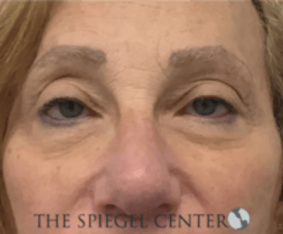 Blepharoplasty Before & After Gallery - Patient 136570 - Image 1