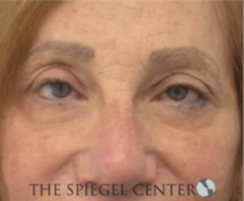 Blepharoplasty Before & After Gallery - Patient 136570 - Image 2