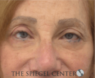 Blepharoplasty Before & After Gallery - Patient 136570 - Image 2