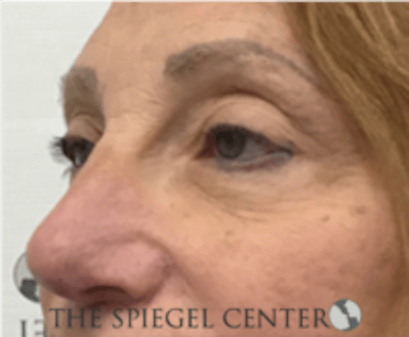 Blepharoplasty Before & After Gallery - Patient 136570 - Image 3