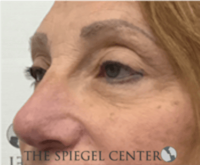 Blepharoplasty Before & After Gallery - Patient 136570 - Image 3