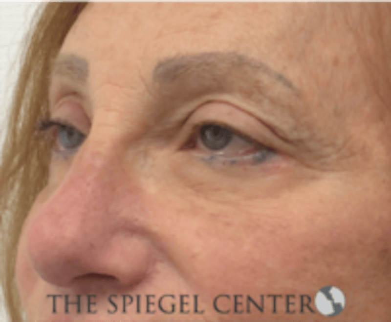 Blepharoplasty Before & After Gallery - Patient 136570 - Image 4