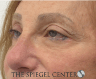 Blepharoplasty Before & After Gallery - Patient 136570 - Image 4