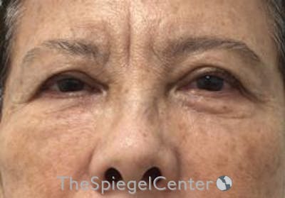 Blepharoplasty Before & After Gallery - Patient 165782 - Image 1