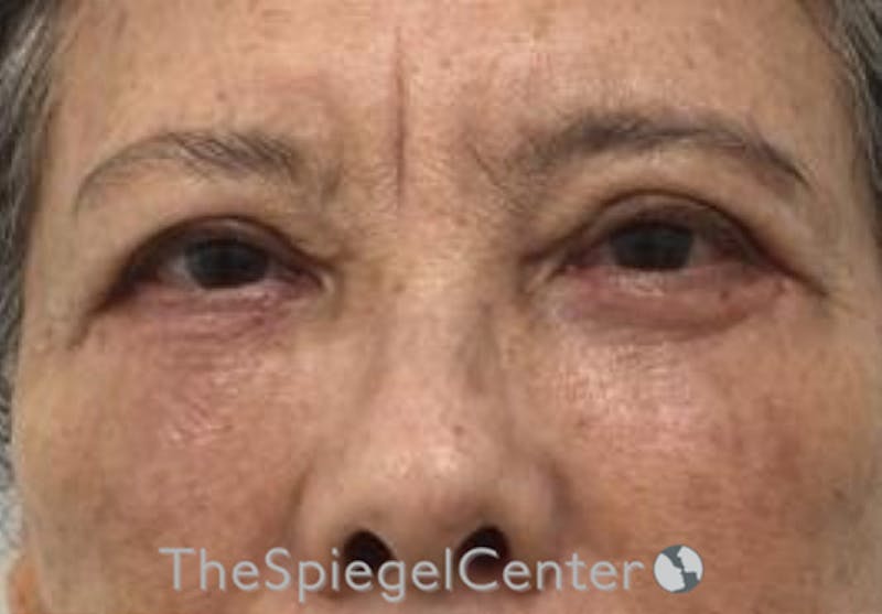 Blepharoplasty Before & After Gallery - Patient 165782 - Image 2