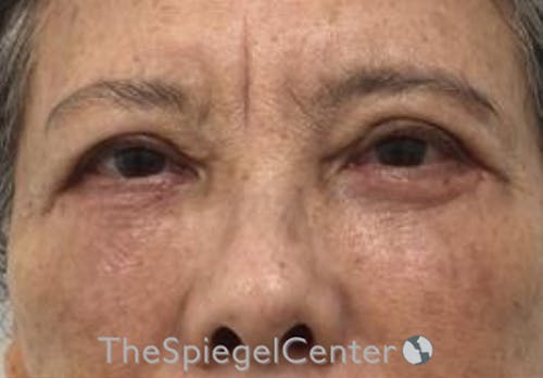 Blepharoplasty Before & After Gallery - Patient 165782 - Image 2